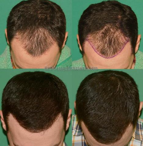 Before and after hair restoration procedure images