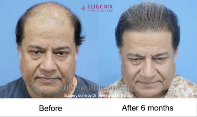 Hair transplantation surgery before and after images