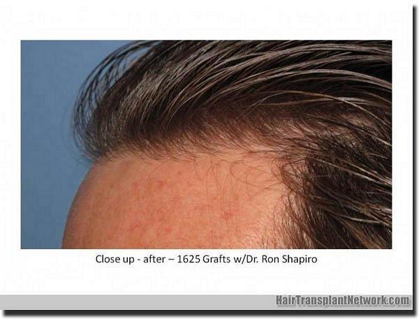 Hair restoration procedure results