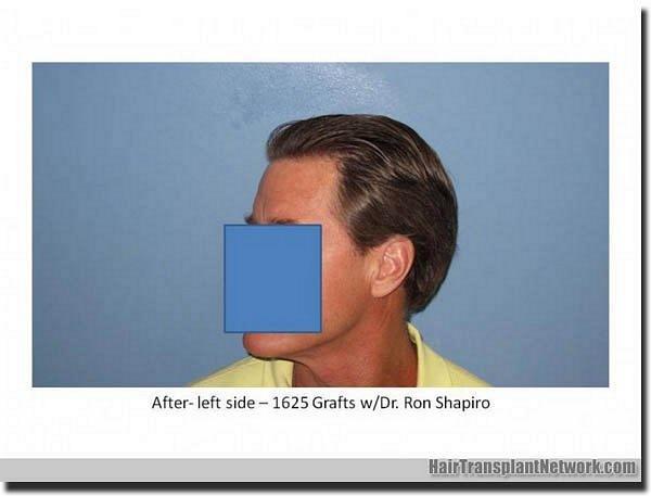 Hair restoration procedure results