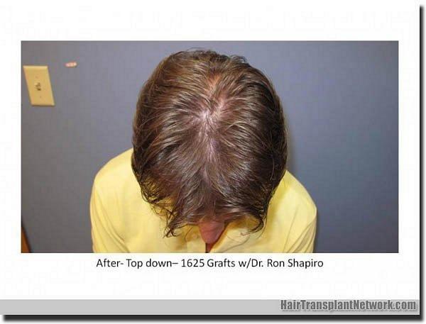 Hair restoration procedure results