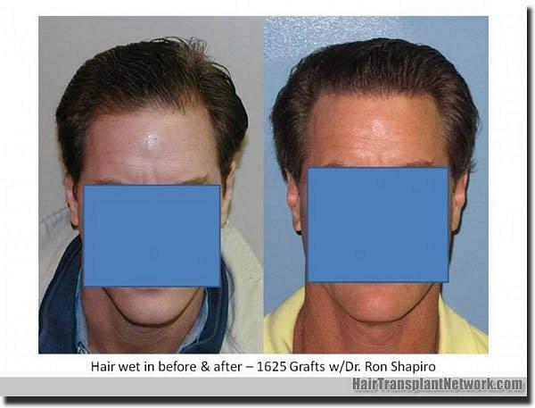 Hair restoration procedure results