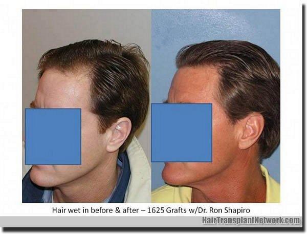 Hair restoration procedure results