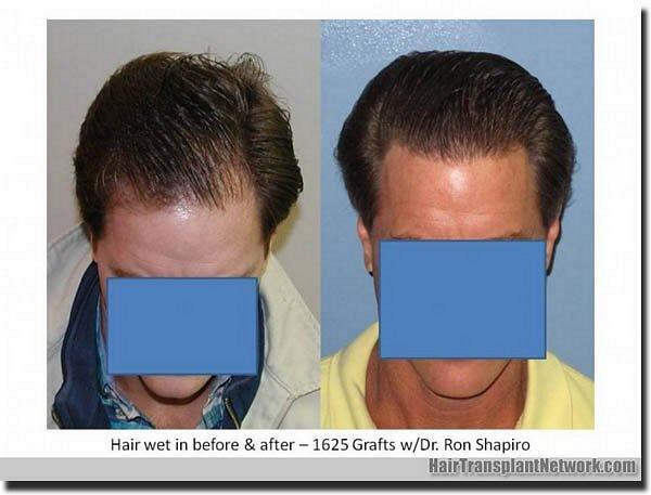 Hair restoration procedure results