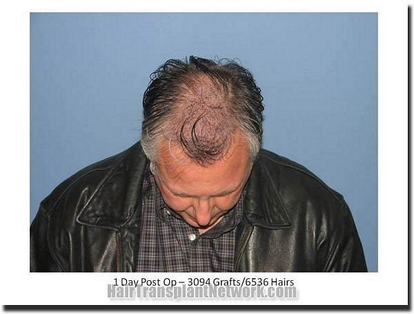 Hair restoration procedure results