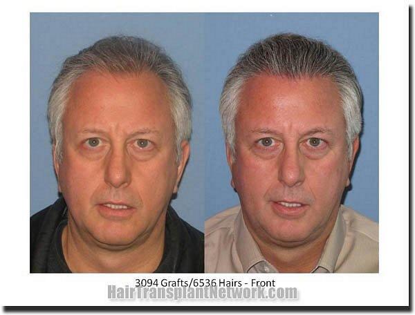 Hair restoration procedure results