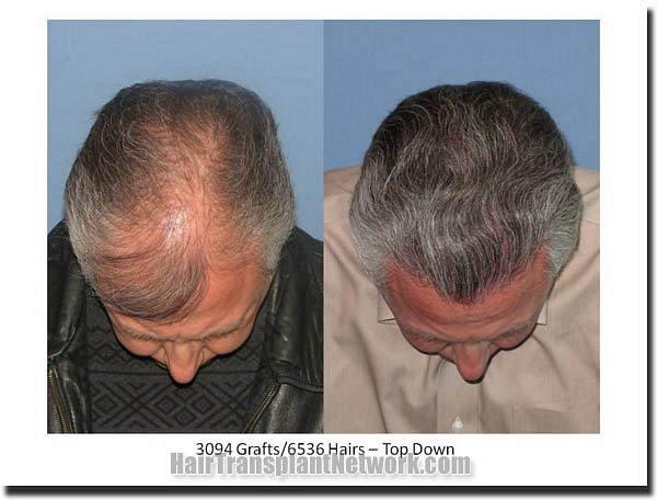 Hair restoration procedure results