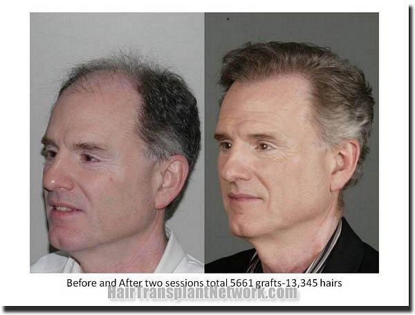 Hair restoration procedure results