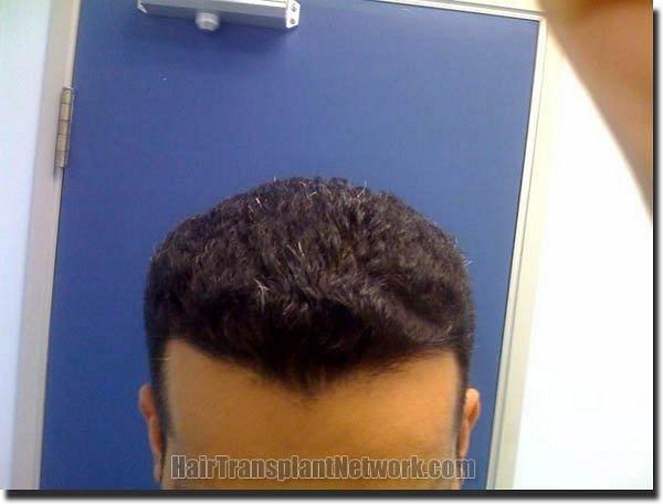 Hair restoration procedure results