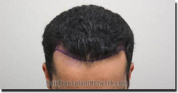 Hair restoration procedure results