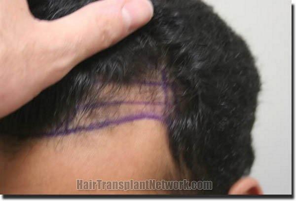 Hair restoration procedure results