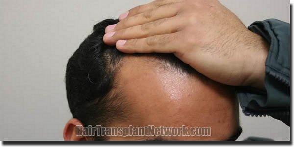 Hair restoration procedure results