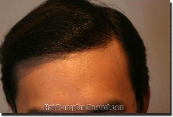 Hair restoration procedure results