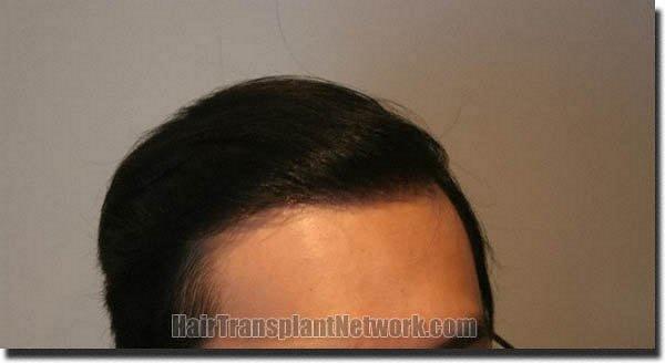 Hair restoration procedure results