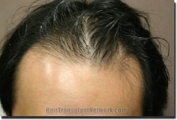 Hair restoration procedure results