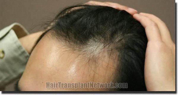 Hair restoration procedure results