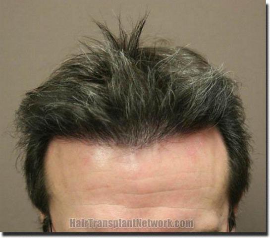 Hair restoration procedure results