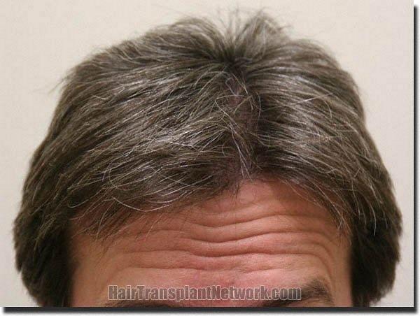 Hair restoration procedure results