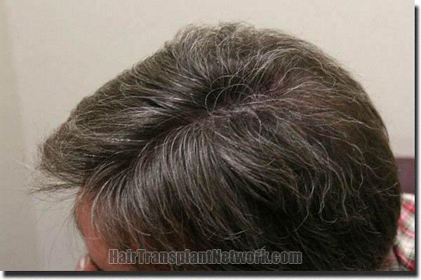 Hair restoration procedure results