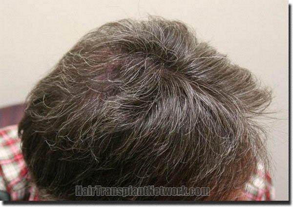 Hair restoration procedure results