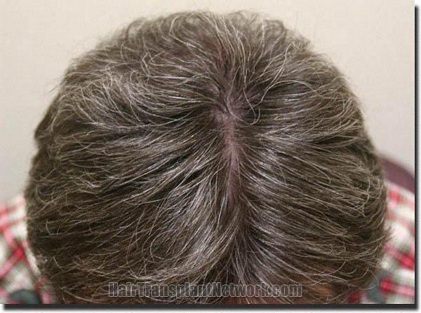 Hair restoration procedure results