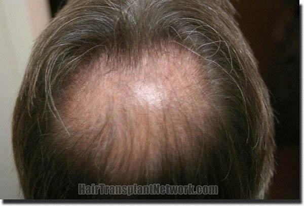 Hair restoration procedure results