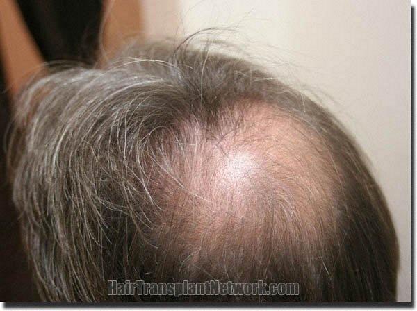 Hair restoration procedure results