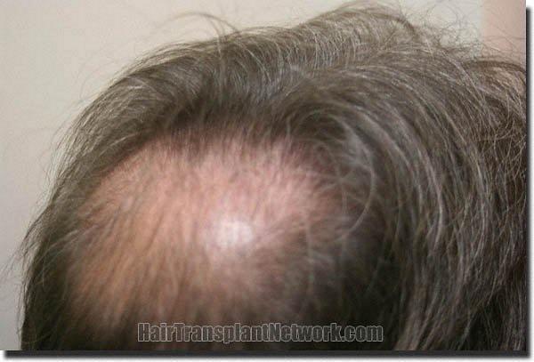 Hair restoration procedure results