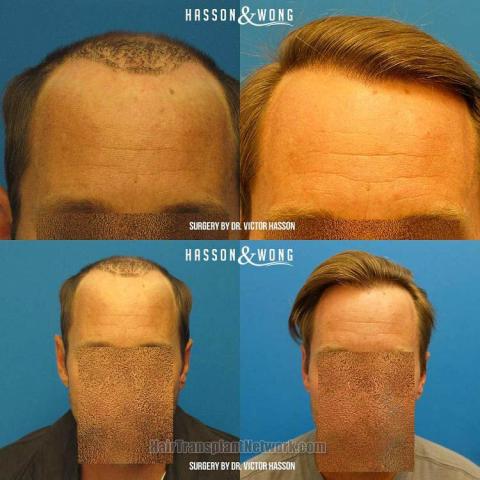 Hair restoration procedure before and after results