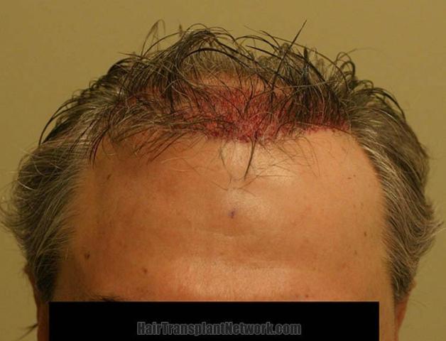 Hair transplantation surgery immediate postoperative