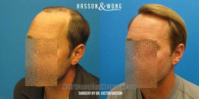 Hair transplantation surgery before and after pictures