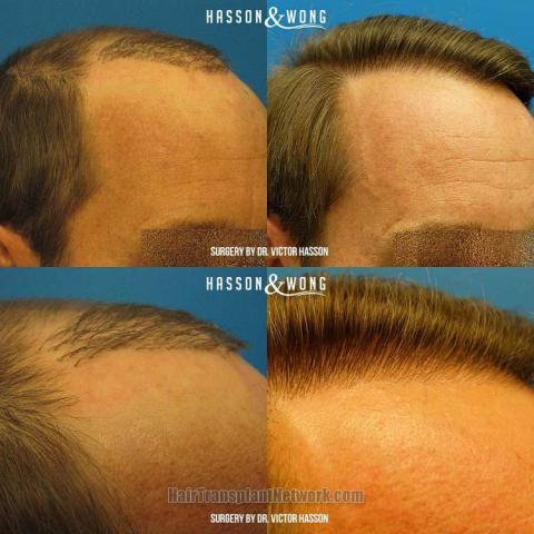 Hair transplantation surgery before and after images