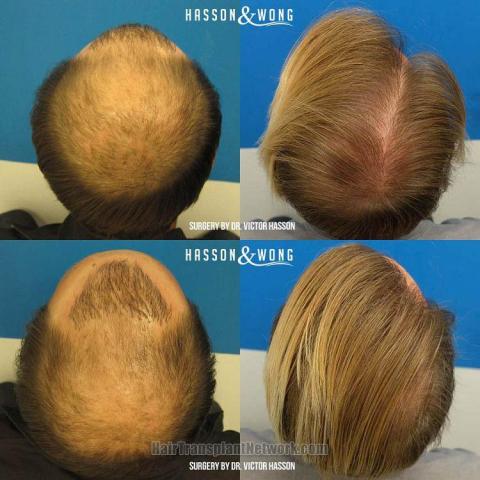 Hair restoration procedure before and after pictures