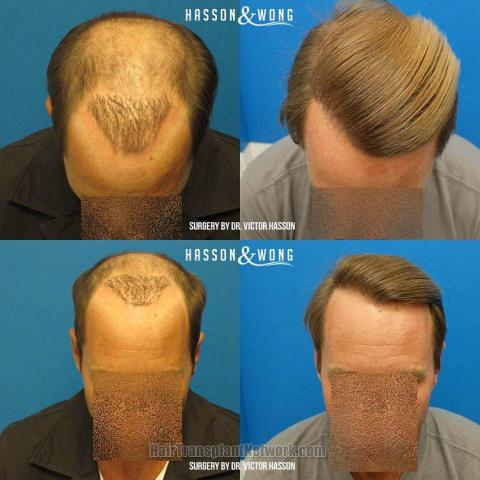 Hair restoration procedure before and after results