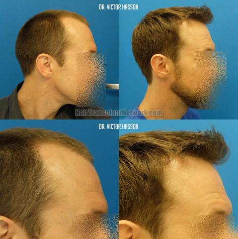 Hair restoration procedure before and after results