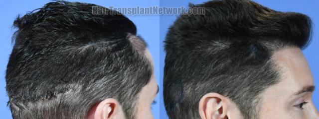 Hair transplantation surgery before and after images