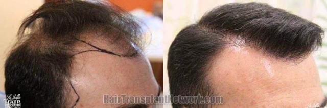 Hair transplantation surgery before and after photos