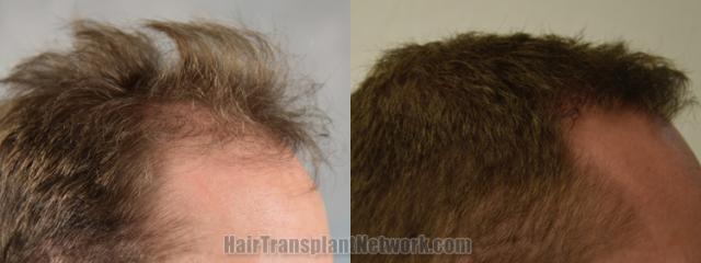 Hair transplantation surgery before and after images