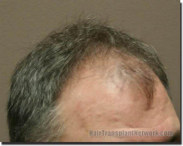 Hair restoration procedure results