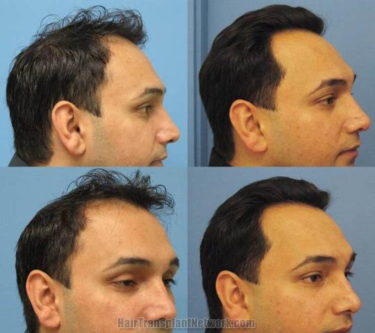 Hair transplant before and after photos