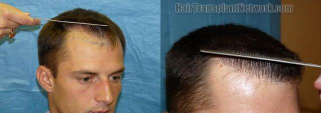 Right view before and after hair transplantation