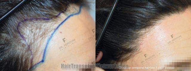 Hair transplantation surgery before and after images