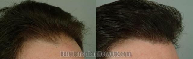 Hair transplantation surgery before and after photos