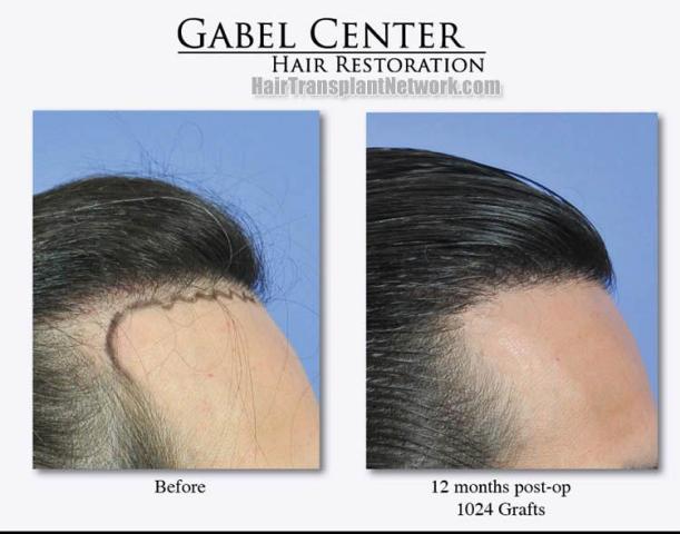 Hair restoration procedure before and after results