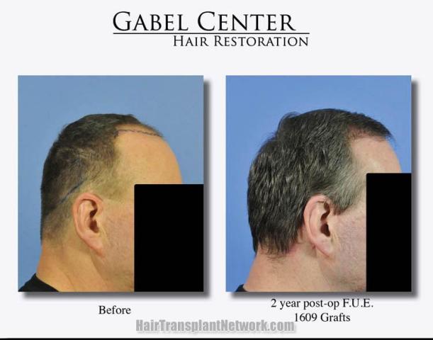 Hair transplantation surgery before and after photos