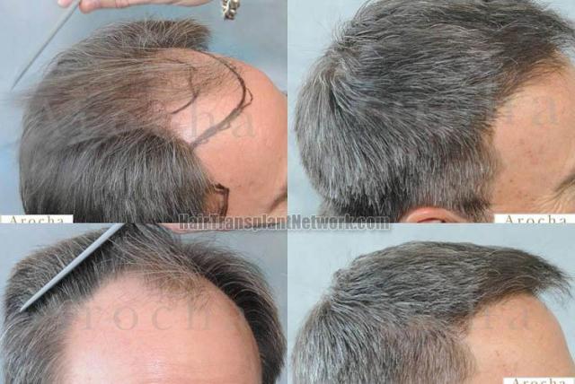 Hair transplantation surgery before and after photos