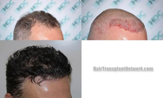 Hair transplantation surgery before and after photos