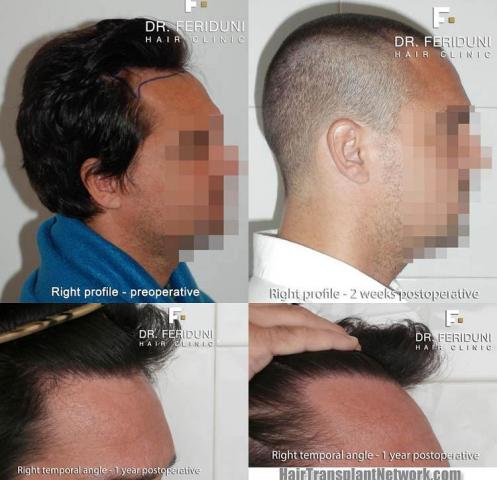 Hair transplantation surgery before and after photos