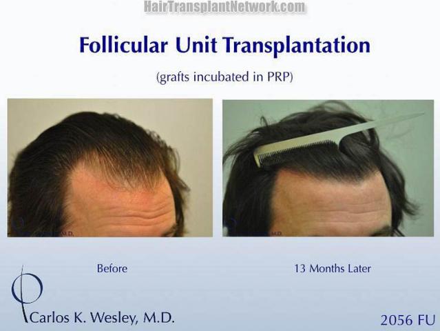 Hair transplantation surgery before and after images