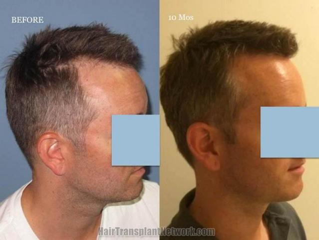 Hair transplantation surgery before and after images